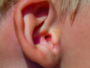 Close-up of a human ear with swimmer's ear, showing irritated and inflamed skin around the ear canal, with some visible crusting. The person's hair is slightly visible in the top right corner, conveying the discomfort often associated with ear pain.