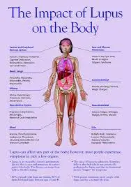 Diagram titled "The Impact of Lupus on the Body," featuring an illustrated human figure. Arrows point to various body systems, joints, and organs with labels describing lupus symptoms and effects. Text at the bottom explains lupus's potential impact within rheumatology on body systems.