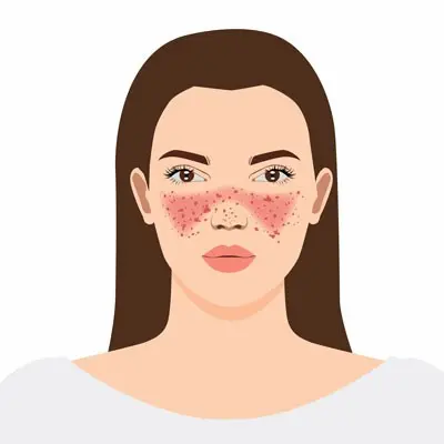 Illustration of a woman with long brown hair, exhibiting facial redness and small blemishes across her cheeks and nose, often seen in rheumatology conditions like lupus. She wears a white shirt, set against a plain white background.