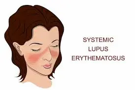 Illustration of a woman with brown hair displaying a butterfly-shaped rash across her cheeks and nose, commonly linked to lupus. Text on the right reads, "Systemic Lupus Erythematosus," highlighting its impact in rheumatology and potential joint involvement.