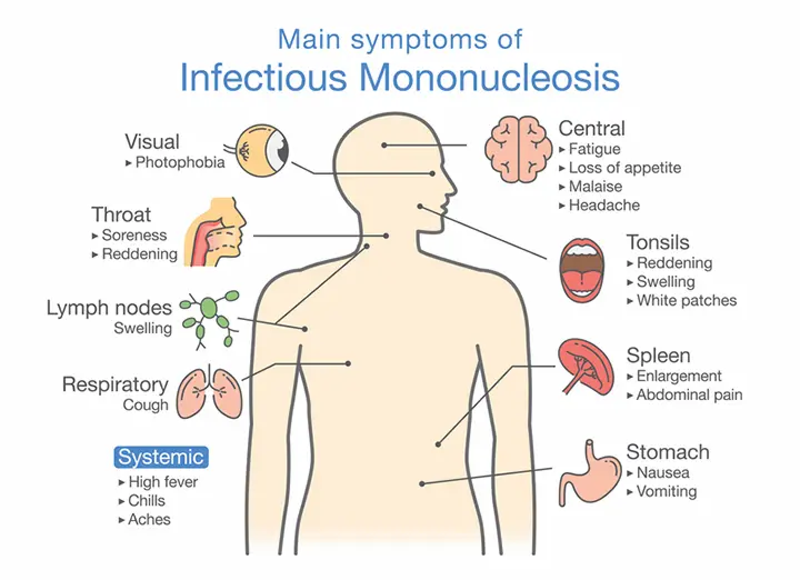 Una infografía informativa que detalla los síntomas de la mononucleosis. Esté atento a problemas visuales, dolor de garganta, inflamación de los ganglios linfáticos, tos respiratoria, fiebre, fatiga, problemas de amígdalas, agrandamiento del bazo y náuseas, todos ellos indicadores clave de esta afección infecciosa.