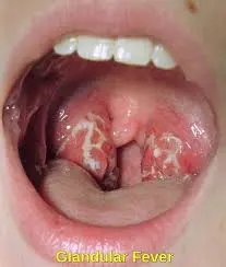 Close-up of an open mouth showing red and inflamed tonsils with white patches, indicative of an infection. The term "Glandular Fever," also known as mononucleosis, is labeled at the bottom.