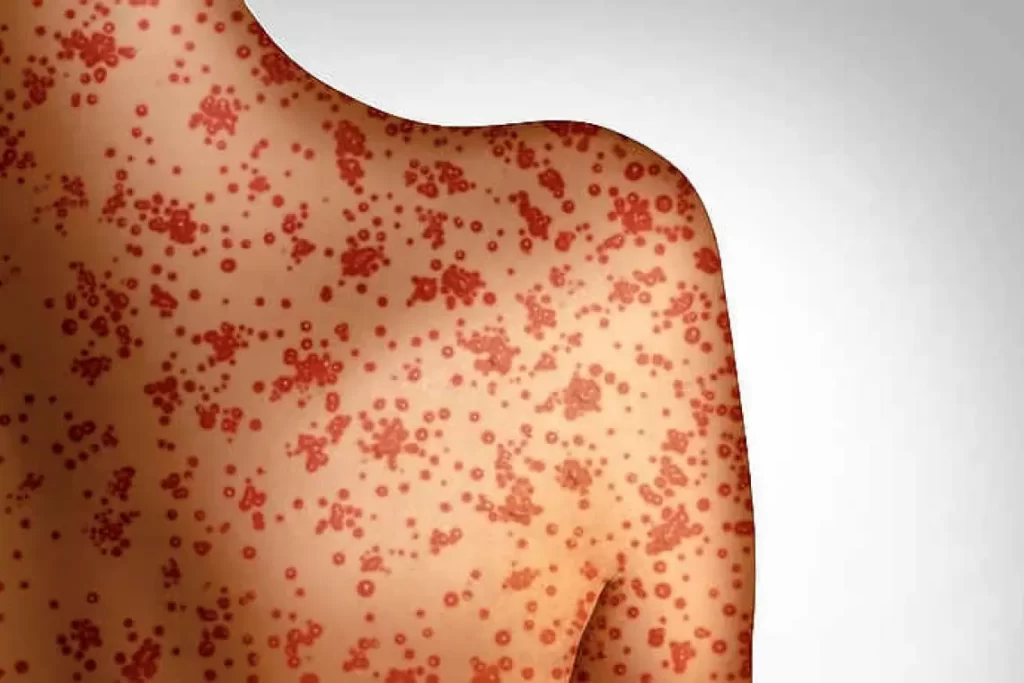 Image showing a person's upper body and shoulder covered in red spots and rashes, possibly indicating a skin condition or an allergic reaction, potentially from measles. The background is grey and white, with the focus primarily on the affected skin.