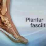 image of plantar facilial pain