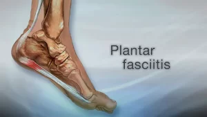 image of plantar facilial pain