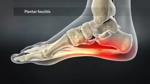 Ilustración de un pie humano que muestra los huesos y la fascia plantar. La fascia plantar, que se extiende a lo largo de la planta desde el talón hasta los dedos, está resaltada en rojo, lo que indica una inflamación asociada con la fascitis plantar. Una etiqueta dice "Fascitis plantar".