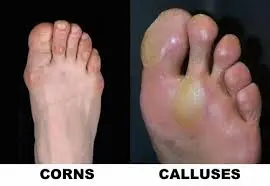 Side-by-side comparison of feet: the left image shows toes with corns, while the right image displays a foot with calluses. The skin appears thickened and calleous in both cases.