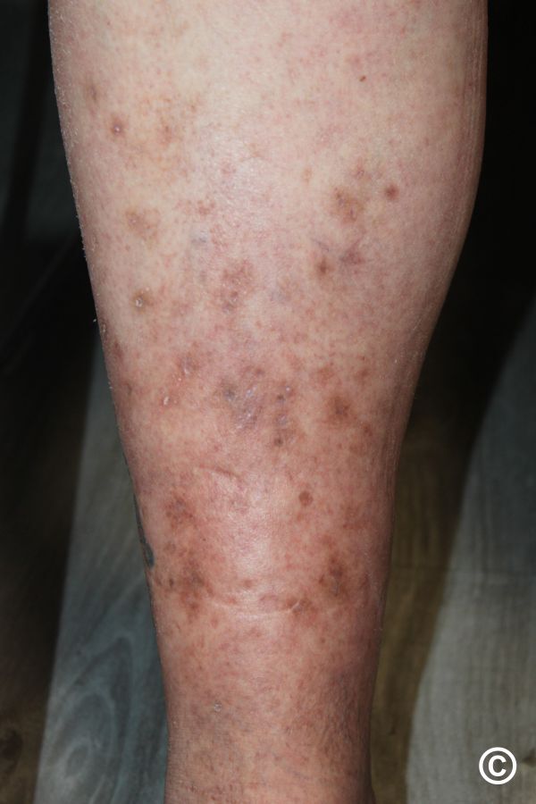 A close-up photo of a person's lower leg displaying various small, dark spots and patches on their skin. The affected area shows signs of discoloration and possible lesions. The surrounding skin appears pale and slightly textured.