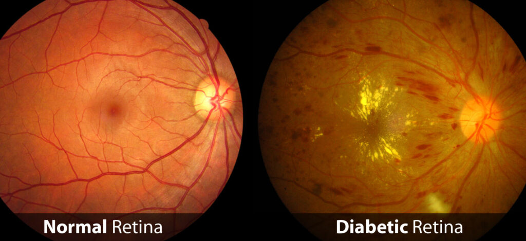 Comparación lado a lado de una retina normal y una retina diabética. La retina normal está sana con vasos sanguíneos claros, mientras que la retina diabética muestra signos de daño, incluidas manchas amarillentas e irregularidades en los vasos sanguíneos. Las etiquetas en la parte inferior indican "Retina normal" y "Retina diabética".  