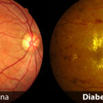 Side-by-side comparison of a normal retina and a diabetic retina. The normal retina is healthy with clear blood vessels, while the diabetic retina shows signs of damage, including yellowish spots and irregularities in the blood vessels. Labels at the bottom indicate "Normal Retina" and "Diabetic Retina.