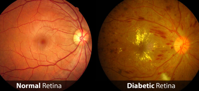 Side-by-side comparison of a normal retina and a diabetic retina. The normal retina is healthy with clear blood vessels, while the diabetic retina shows signs of damage, including yellowish spots and irregularities in the blood vessels. Labels at the bottom indicate "Normal Retina" and "Diabetic Retina.