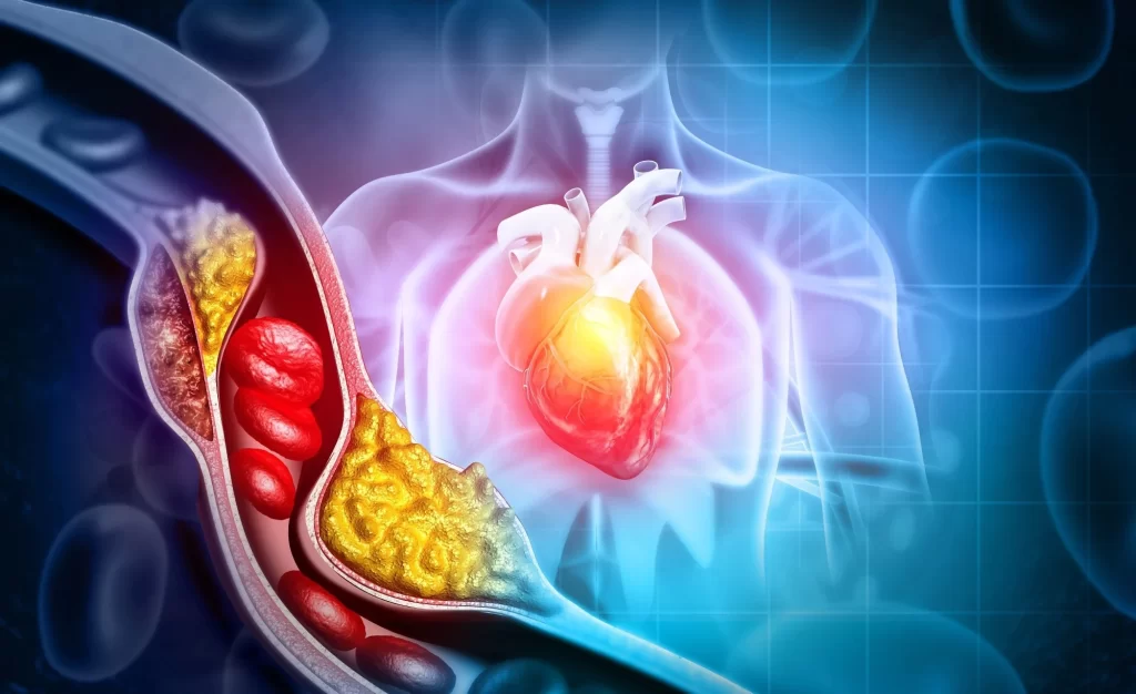 Ilustración digital que muestra una arteria obstruida que contiene acumulación de placa, lo que restringe el flujo sanguíneo. La arteria bloqueada se superpone a un torso humano semitransparente con un corazón resaltado, que simboliza la enfermedad cardíaca y su impacto en la salud cardiovascular. 