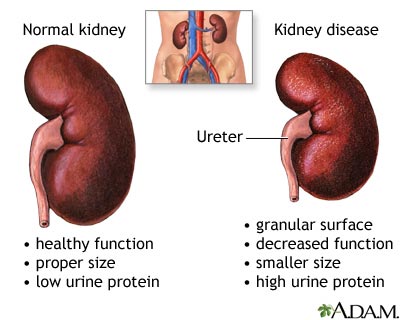 Comparison image showing a normal kidney on the left and a kidney with disease, possibly due to diabetes, on the right. The normal kidney, larger and smooth, is noted for healthy function and low urine protein. The diseased kidney is smaller, has a granular surface, decreased function, and high urine protein.