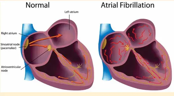 Diagram comparing a normal heart with one experiencing atrial fib. The left side shows a healthy heart with clear electrical pathways, while the right side illustrates chaotic activity in the atria, characteristic of atrial fib.