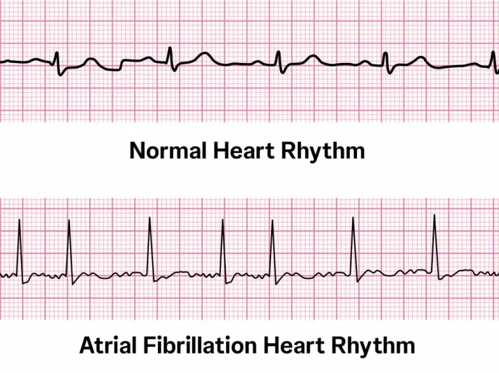 example of AFIB ECG