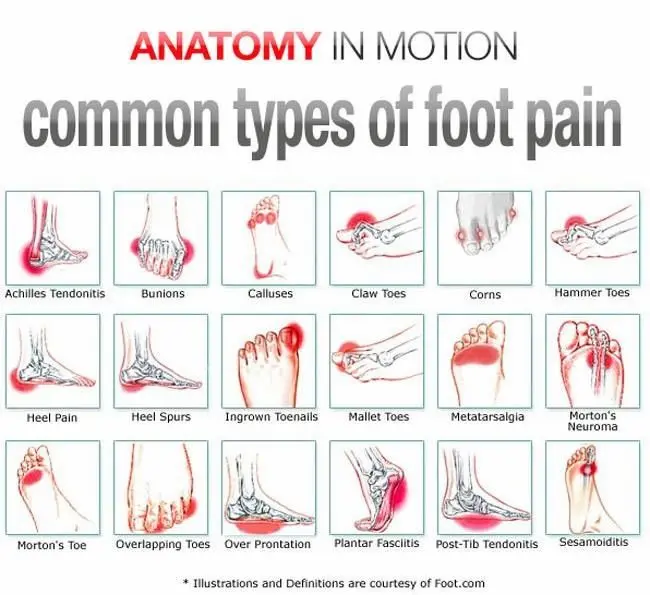 Diagram titled "Anatomy in Motion: Common Types of Foot Pain" featuring illustrations of various foot ailments, such as Achilles Tendonitis, Bunions, Calluses, Claw Toes, Corns, and Heel Spurs. Highlighted areas in red vividly indicate sources of foot pain.