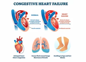 Ilustración que compara un corazón normal con un corazón con insuficiencia cardíaca, en la que se destaca la reducción del volumen sanguíneo y un ventrículo dilatado. Incluye síntomas como congestión en el pecho, dificultad para respirar y piernas hinchadas.