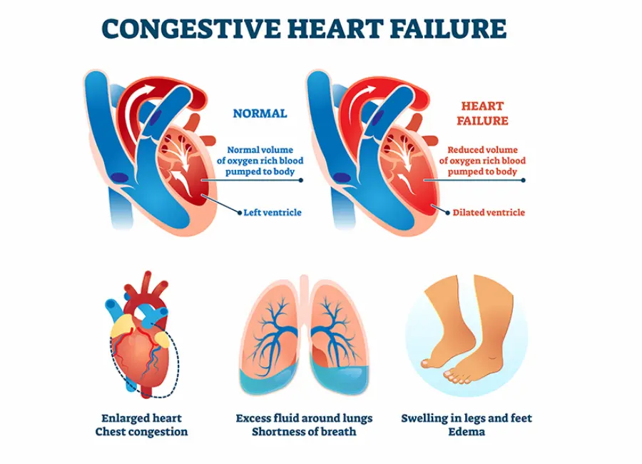 Diagram illustrating differences between a normal heart and one with Congestive Heart Failure (CHF). The normal heart pumps oxygen-rich blood efficiently, while the failing heart has a dilated ventricle. Symptoms include chest congestion, lung fluid, and swelling in legs and feet.