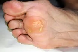 Close-up of the bottom of a foot showing a callus on the ball of the foot. The skin is thickened and yellowish, a common result of repeated friction or pressure on the area.