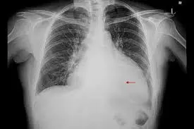 Radiografía de tórax que muestra los pulmones y el corazón. La imagen tiene una flecha roja que señala una zona del lado derecho del tórax, lo que puede indicar una observación médica o una anomalía.