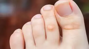 Close-up image of toes, with a noticeable corn on the middle toe. The corn appears as a small, raised, circular area on the skin. The background is blurred, emphasizing the toes.