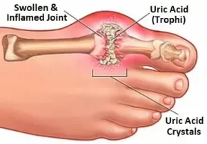 An illustration of a foot with labels pointing to a swollen and inflamed joint, uric acid crystals, and a uric acid (tophus) buildup on the big toe, depicting symptoms of gout.