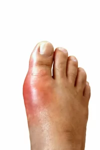 A close-up of a foot with a visibly swollen and red big toe, suggesting inflammation or an ailment. The surrounding skin appears smooth, with the redness concentrated around the joint. The background is white, highlighting the condition.