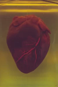 A preserved enlarged heart lies in a transparent container filled with yellowish liquid. The dark heart, with visible red veins, creates a warm yet clinical atmosphere under the lighting.