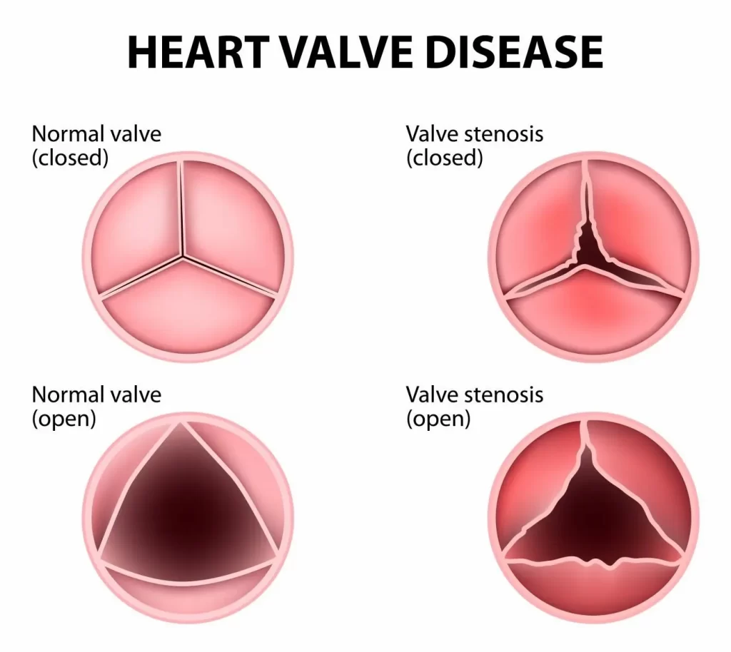 Diagrama de enfermedad valvular cardíaca. Arriba a la izquierda: válvula cerrada normal. Abajo a la izquierda: válvula abierta normal. Arriba a la derecha: estenosis de la válvula cerrada que muestra engrosamiento. Abajo a la derecha: estenosis de la válvula abierta con abertura estrecha y posible soplos cardíacos. Muestra el contraste entre los estados normal y enfermo.