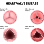 Diagram illustrating heart valve disease. Top row features closed valves, with normal on the left and stenosis on the right. Bottom row displays open valves: normal on the left and stenosis, often associated with a heart murmur, showing a narrowed opening on the right.