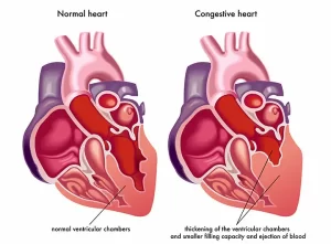 Illustration comparing a normal heart and one affected by congestive heart failure (CHF). The normal heart features regular ventricular chambers, while the CHF-impacted heart displays thickened chambers with reduced filling capacity and ejection of blood.