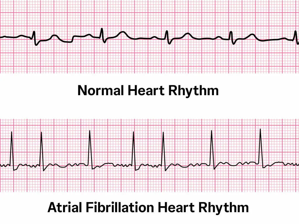 Comparación de dos tiras de ECG: la tira superior, generada por borrador automático, muestra un patrón regular denominado "Ritmo cardíaco normal". La tira inferior muestra un patrón irregular denominado "Ritmo cardíaco por fibrilación auricular". Ambas están colocadas sobre un fondo de papel cuadriculado.