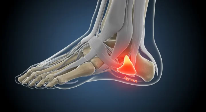 Ilustración anatómica de un pie que muestra huesos, tendones y ligamentos. La imagen resalta el área del talón en rojo, lo que indica inflamación o lesión. La superposición semitransparente revela la estructura interna contra un fondo oscuro.