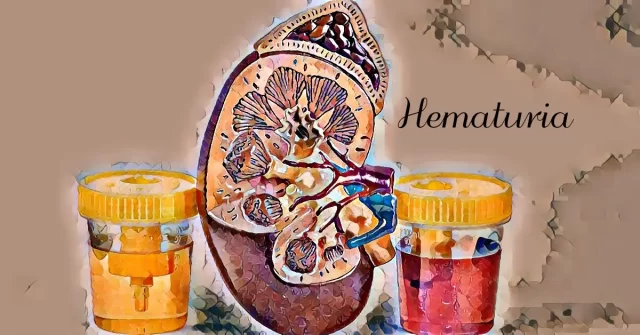 Ilustración de riñones con muestras de orina. Una muestra es amarilla y la otra roja, lo que indica hematuria. La palabra "hematuria" se muestra de forma destacada en el lado derecho, lo que sugiere síntomas como disuria.