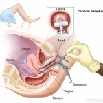 Illustration of a cervical sampling procedure promoting health awareness. A speculum is inserted into the vagina to access the cervix. A gloved hand uses a brush to collect cells. An inset shows a close-up of the brush touching the cervix, with labels identifying anatomical parts for cervical health.