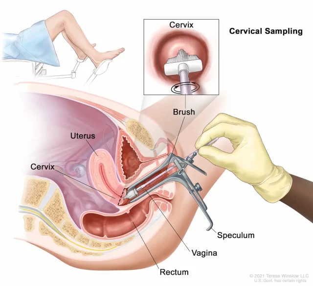 Illustration of a cervical sampling procedure promoting health awareness. A speculum is inserted into the vagina to access the cervix. A gloved hand uses a brush to collect cells. An inset shows a close-up of the brush touching the cervix, with labels identifying anatomical parts for cervical health.