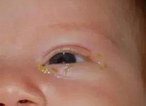 A close-up of a baby's eye with a yellowish crusty discharge around the eyelids, highlighting pediatric eye health concerns like infection or blocked tear duct, especially important during childEyeAwarenessMonth.
