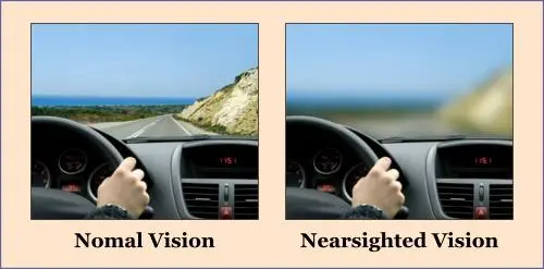 Side-by-side comparison of driving views: left shows clear road and scenery labeled "Normal Vision"; right shows blurred distant view labeled "Nearsighted Vision," similar to how strabismus or lazy eye can affect what you see.