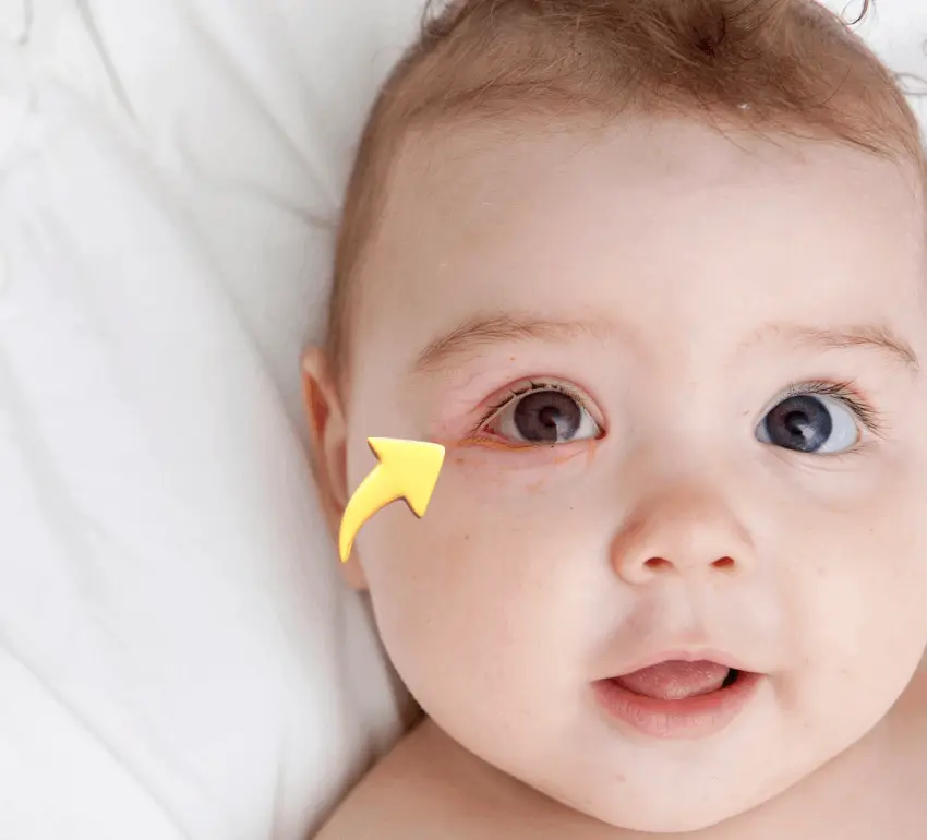 A baby lying on a white blanket with a yellow arrow pointing to redness and discharge in the corner of their left eye, indicating possible conjunctivitis or irritation—raising awareness for childEyeAwarenessMonth.