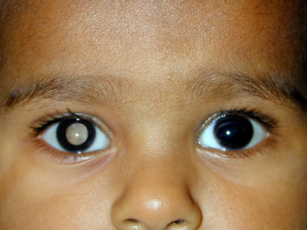 Close-up of a child's face showing two eyes, one with a normal black pupil and the other with a cloudy white pupil, highlighting the importance of pediatric eye health.