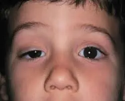 Close-up of a child’s face showing ptosis, with one eyelid noticeably drooping lower than the other—a key concern in pediatric eye health. The child’s eyes are open, highlighting the difference seen during child vision screening.
