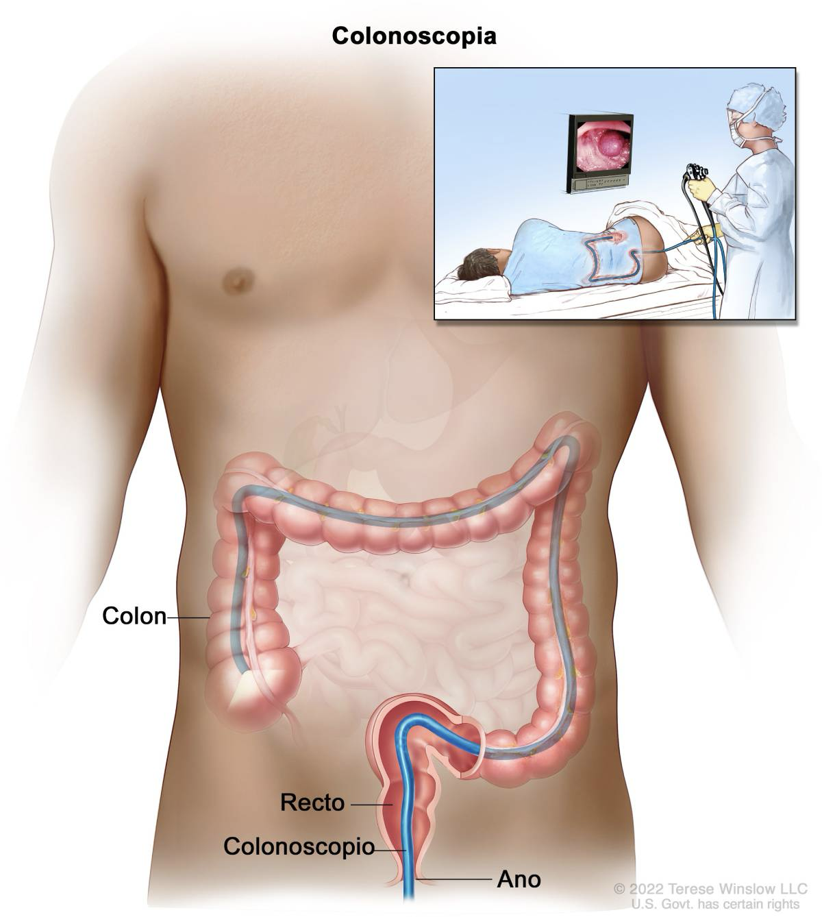 Medical illustration showing a colonoscopy procedure: the large intestine is highlighted, and a flexible colonoscope is inserted through the anus. An inset shows how early detection during a colonoscopy aids cancer prevention.