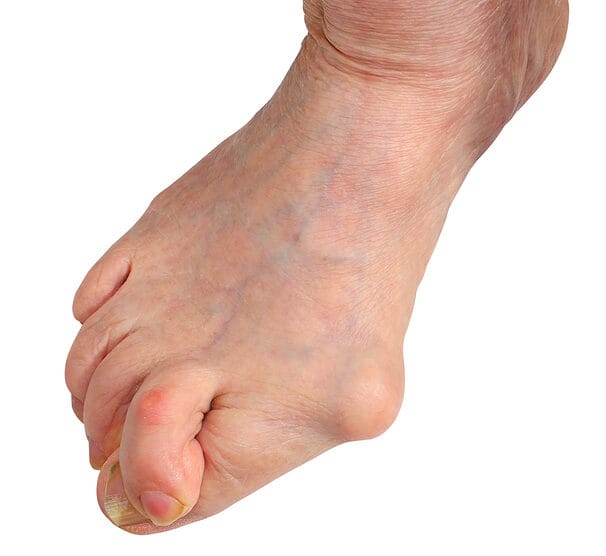 A close-up of a human foot with visible bunion deformity and signs of flat feet, causing the big toe to angle inward. The skin appears aged with dry patches around the ankle. The background is white.