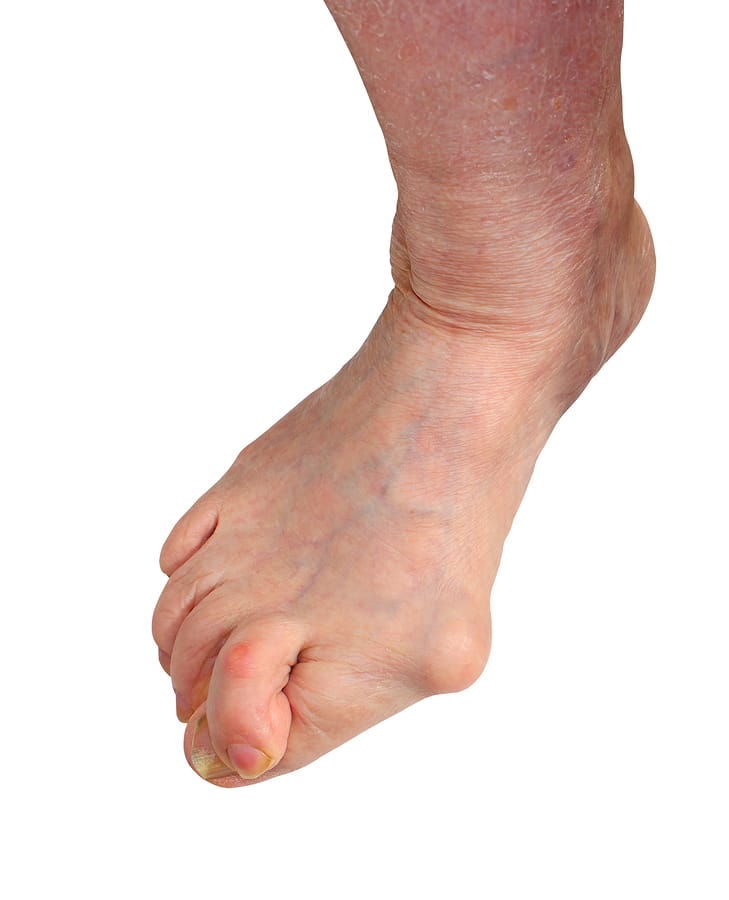 A close-up of a human foot with visible bunion deformity and signs of flat feet, causing the big toe to angle inward. The skin appears aged with dry patches around the ankle. The background is white.