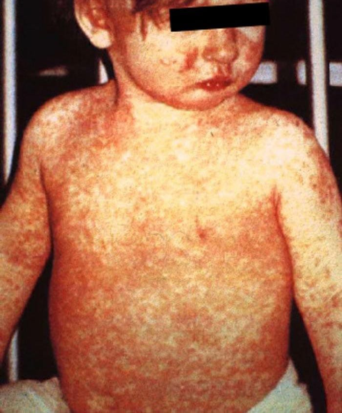 measles-infant trunk chest